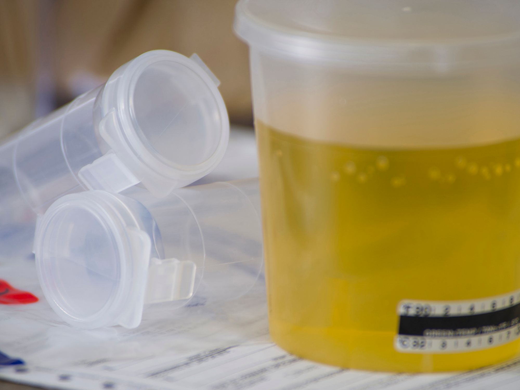 Handling dilute urine specimens