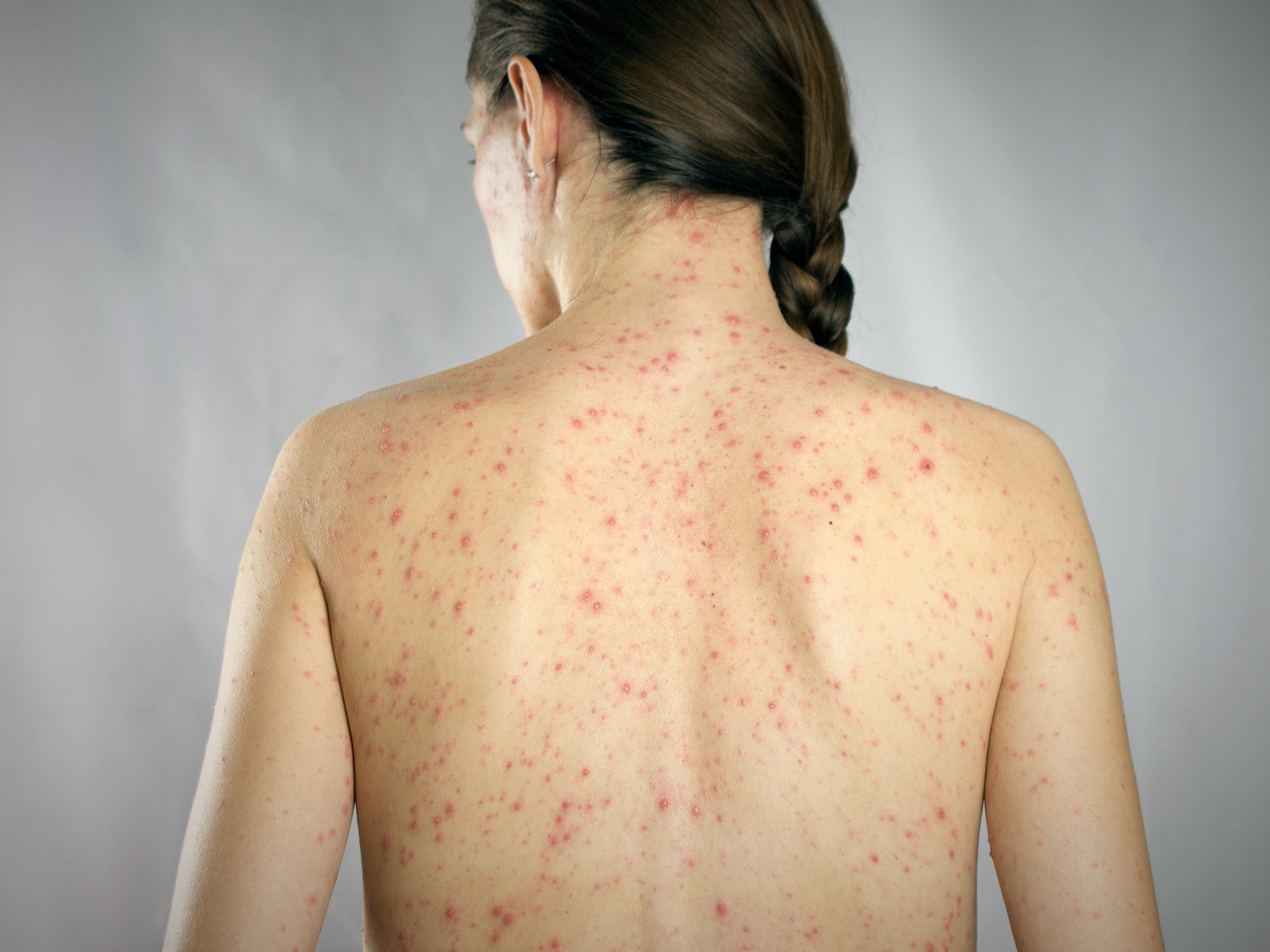 Measles hazard recognition