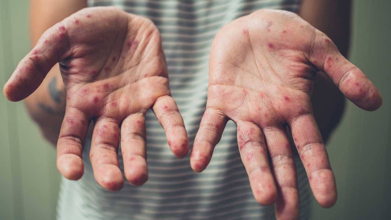Coming to a workplace near you: Measles