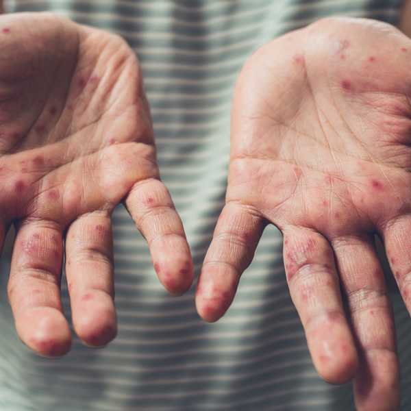 Coming to a workplace near you: Measles