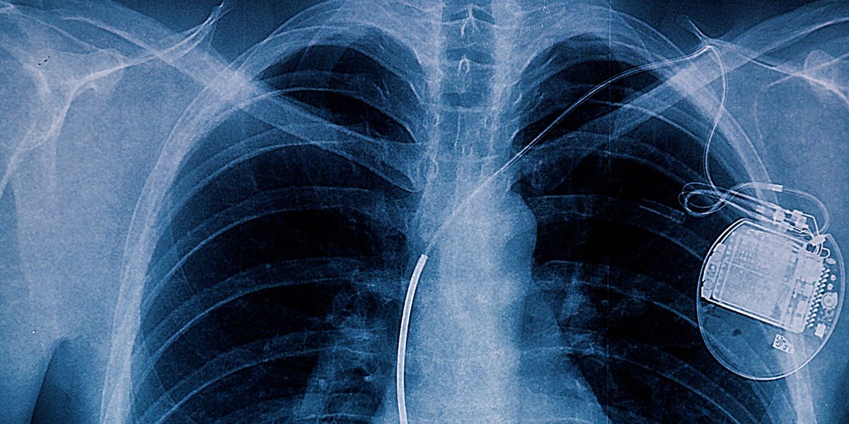 Implanted defibrillators still a no-go for drivers | J. J. Keller