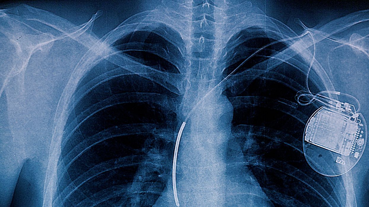 Implanted defibrillators still a no-go for drivers