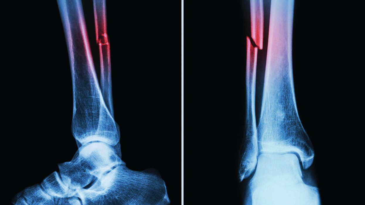 When to enter estimated day counts on the OSHA 300 Log