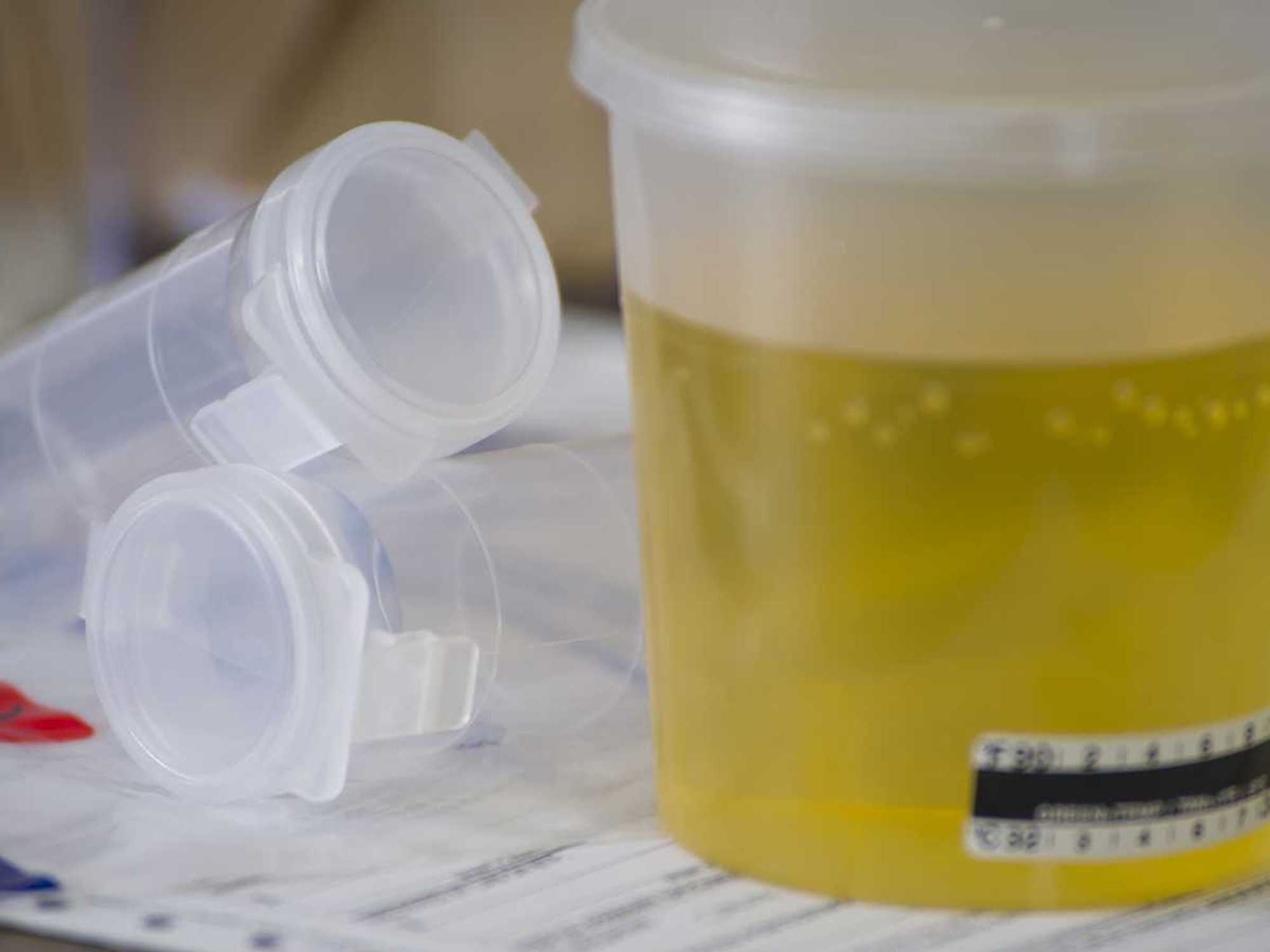 Handling dilute urine specimens